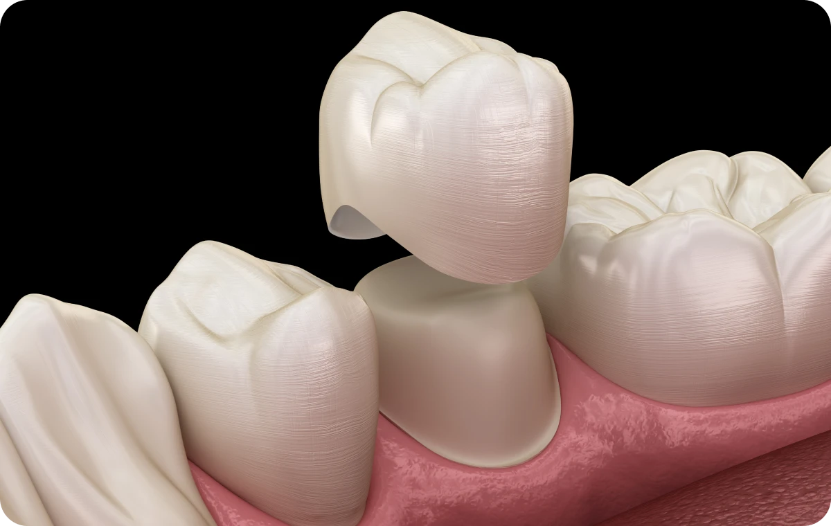 couronne dentaire dentistes bourgoin jaillieu Couronnes céramiques Dentistes Bourgoin-Jallieu | Cabinet dentaire Y2