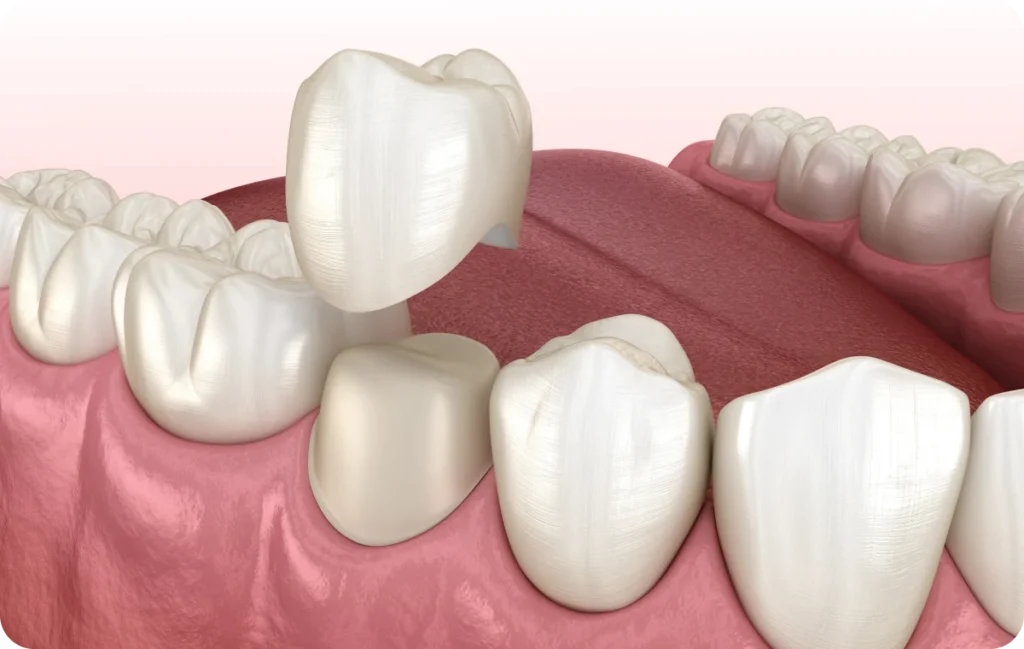 couronne dentiste bourgoin jaillieu couronne dentiste bourgoin jaillieu Inlay, Onlay, Overlay Dentistes Bourgoin-Jallieu | Cabinet dentaire Y2