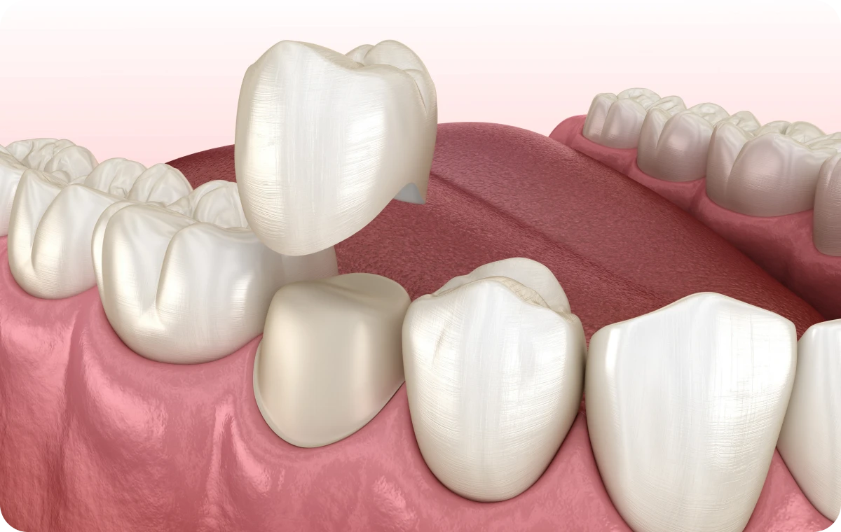 couronne dentiste bourgoin jaillieu Inlay, Onlay, Overlay Dentistes Bourgoin-Jallieu | Cabinet dentaire Y2