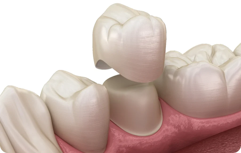 couronne dentistes bourgoin jaillieu couronne dentistes bourgoin jaillieu Inlay, Onlay, Overlay Dentistes Bourgoin-Jallieu | Cabinet dentaire Y2
