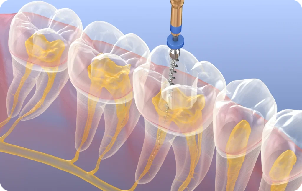 endodontie dentiste bourgoin jaillieu Retraitement endodontique Dentistes Bourgoin-Jallieu | Cabinet dentaire Y2