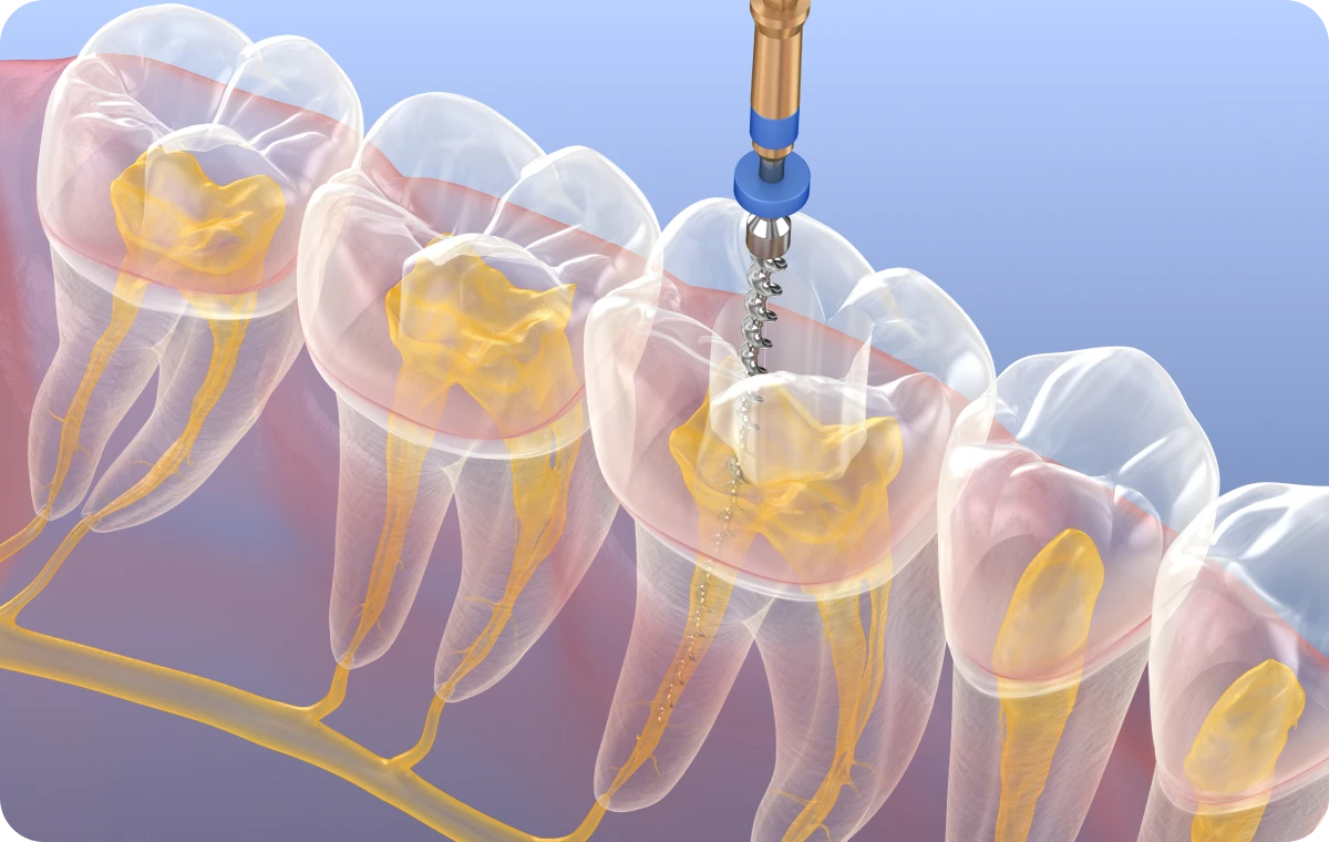 endodontie dentiste bourgoin jaillieu Retraitement endodontique Dentistes Bourgoin-Jallieu | Cabinet dentaire Y2