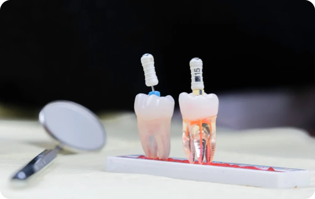 endodontie explication dentiste bourgoin jaillieu endodontie explication dentiste bourgoin jaillieu Traitement endodontique initial Dentistes Bourgoin-Jallieu | Cabinet dentaire Y2