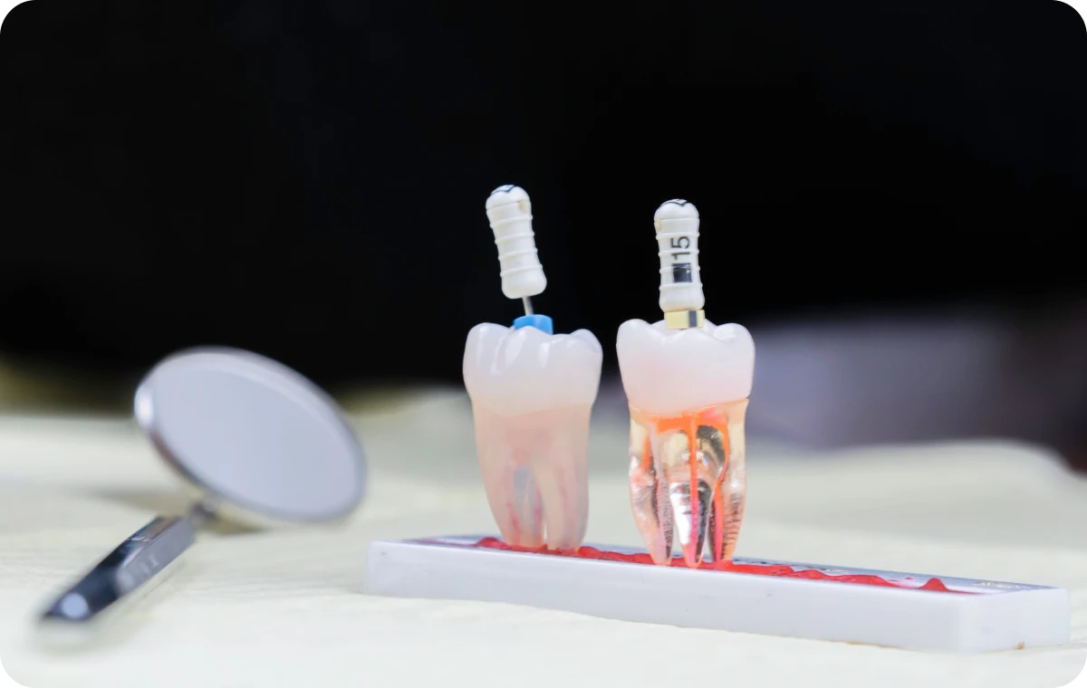 endodontie explication dentiste bourgoin jaillieu Traitement endodontique initial Dentistes Bourgoin-Jallieu | Cabinet dentaire Y2