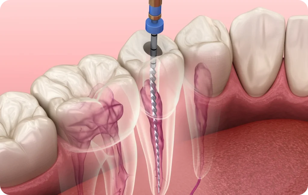 endodontie racines dentistes bourgoin jaillieu Retraitement endodontique Dentistes Bourgoin-Jallieu | Cabinet dentaire Y2
