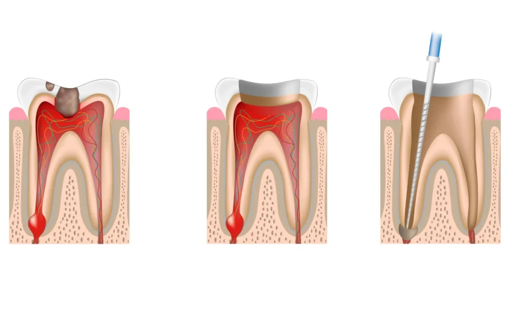 endodontie traitement canal dentiste bourgoin jaillieu endodontie traitement canal dentiste bourgoin jaillieu Traitement endodontique initial Dentistes Bourgoin-Jallieu | Cabinet dentaire Y2