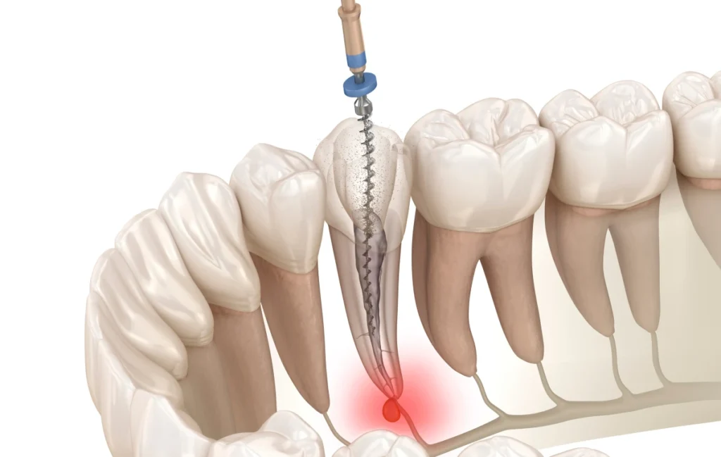 endodontie traitements dentistes bourgoin jaillieu endodontie traitements dentistes bourgoin jaillieu Micro-chirurgie endodontique Dentistes Bourgoin-Jallieu | Cabinet dentaire Y2