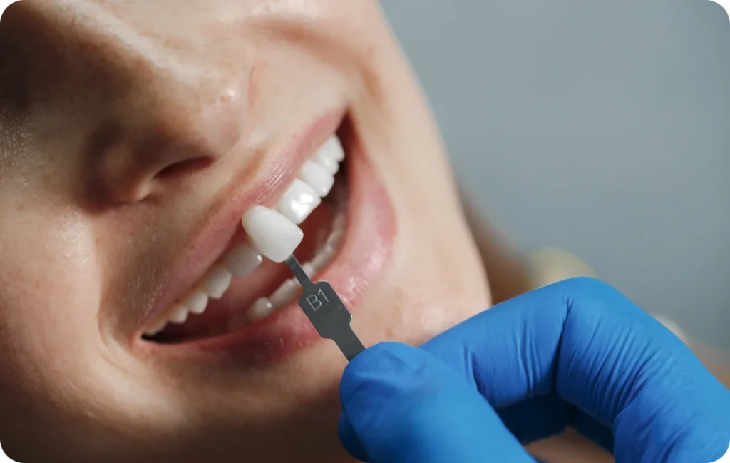 facettes dentistes bourgoin jaillieu facettes dentistes bourgoin jaillieu Facettes dentaires Dentistes Bourgoin-Jallieu | Cabinet dentaire Y2