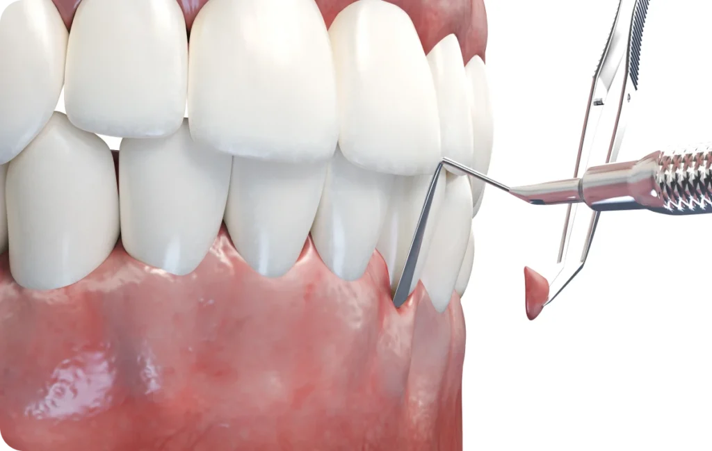 greffe gingivale chirurgie dentiste bourgoin jaillieu greffe gingivale chirurgie dentiste bourgoin jaillieu Greffe de gencives Dentistes Bourgoin-Jallieu | Cabinet dentaire Y2