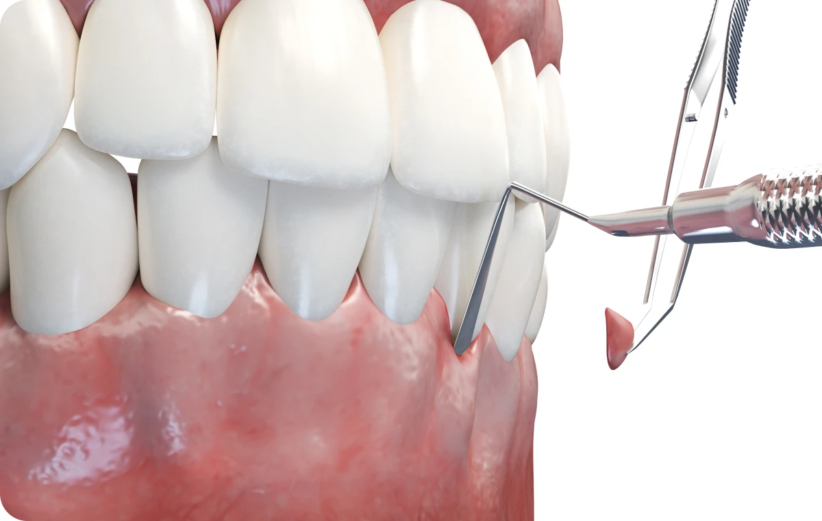 greffe gingivale chirurgie dentiste bourgoin jaillieu Greffe de gencives Dentistes Bourgoin-Jallieu | Cabinet dentaire Y2