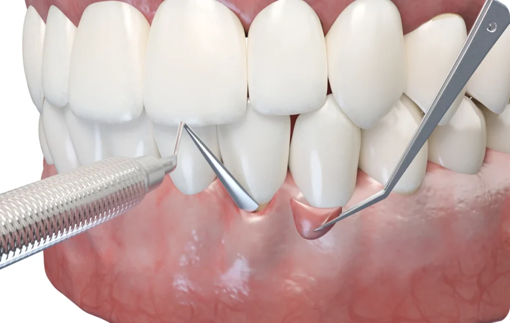 greffe gingivale procedure dentiste bourgoin jaillieu greffe gingivale procedure dentiste bourgoin jaillieu Greffe de gencives Dentistes Bourgoin-Jallieu | Cabinet dentaire Y2