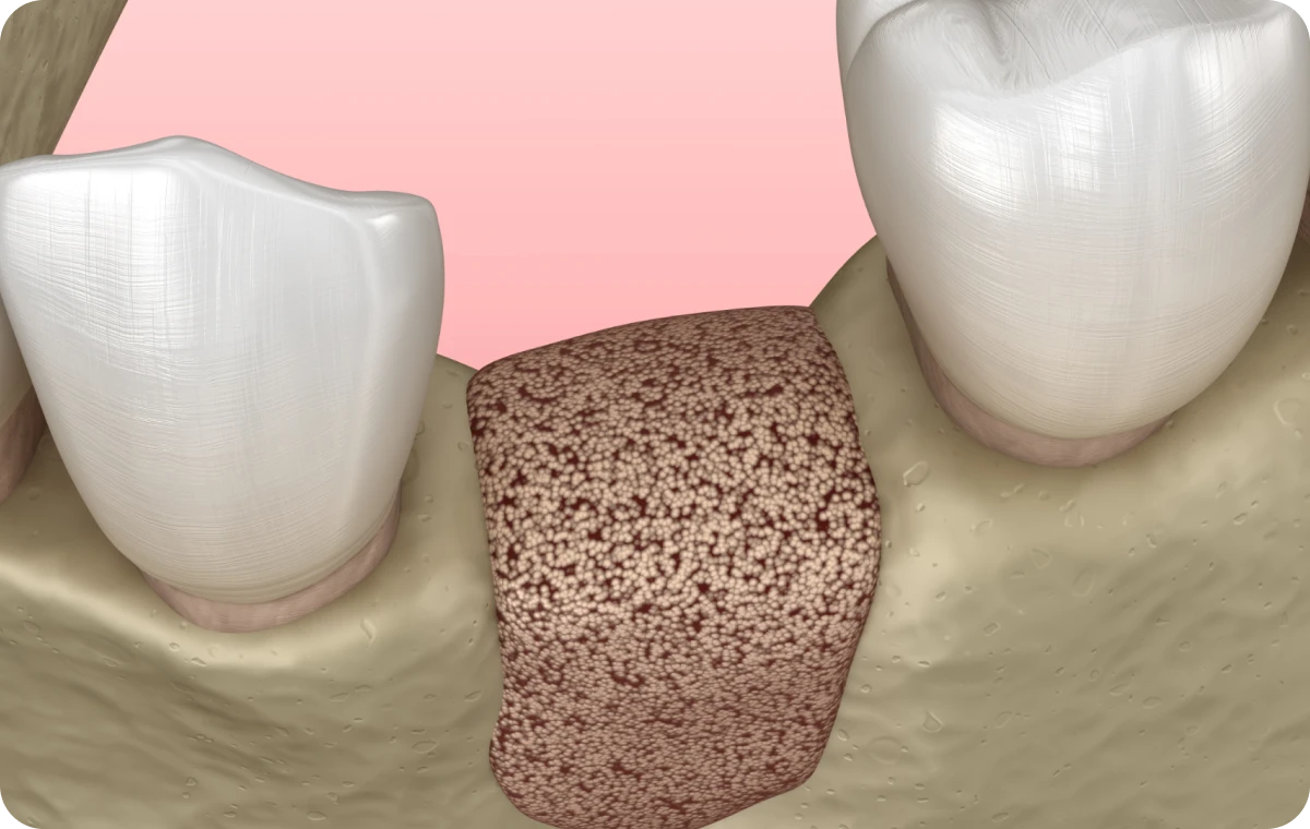 greffe osseuse bourgoin jaillieu Greffes osseuses Dentistes Bourgoin-Jallieu | Cabinet dentaire Y2