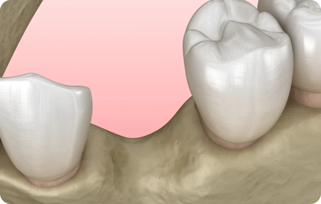 greffe osseuse dentiste bourgoin jaillieu greffe osseuse dentiste bourgoin jaillieu Greffes osseuses Dentistes Bourgoin-Jallieu | Cabinet dentaire Y2