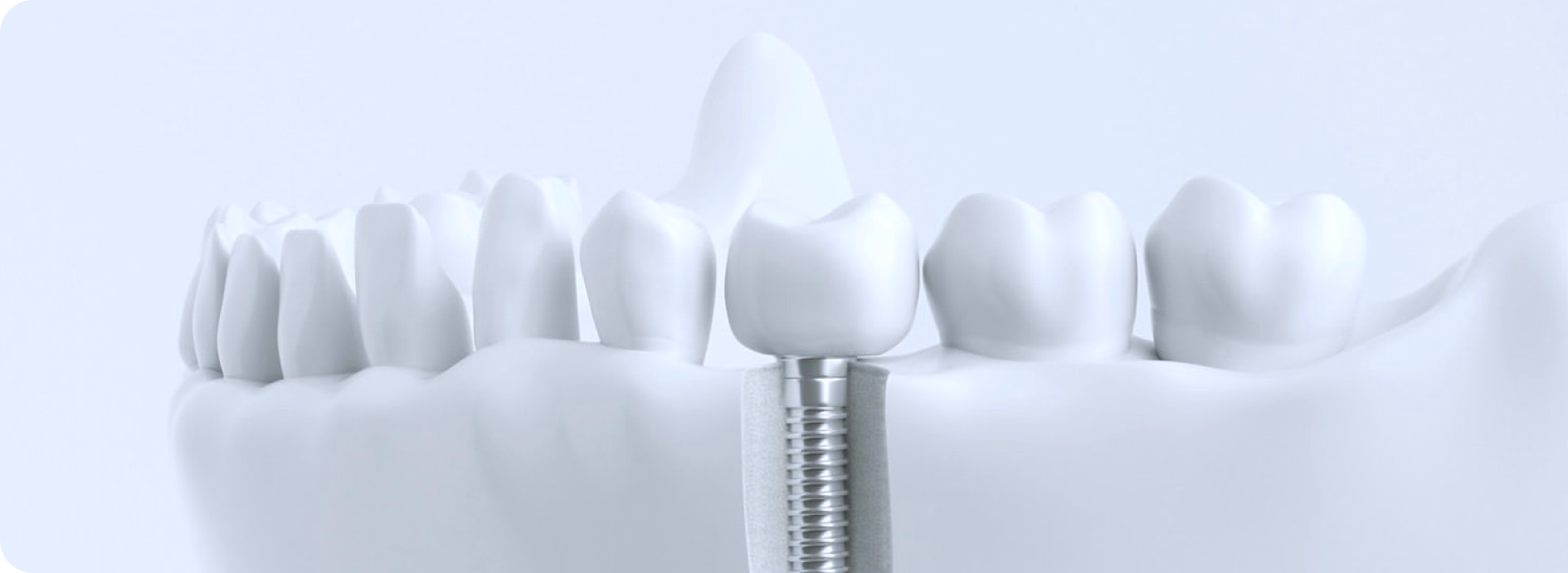 implant chirurgien dentiste bourgoin jeillieu implant chirurgien dentiste bourgoin jeillieu Implant dentaire Dentistes Bourgoin-Jallieu | Cabinet dentaire Y2