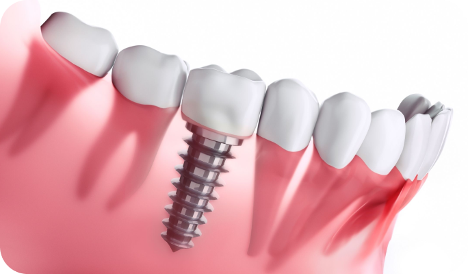 Conseils post-opératoires implant dentaire