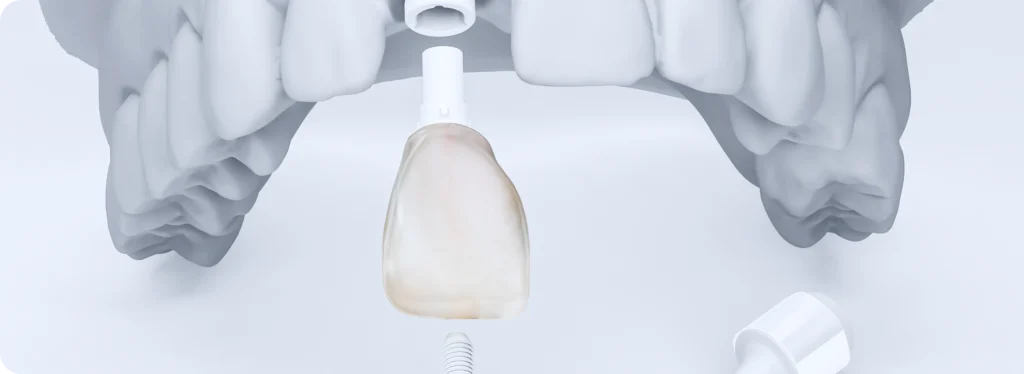 implant unitaire chirurgien dentiste bourgoin jeillieu implant unitaire chirurgien dentiste bourgoin jeillieu Implant dentaire Dentistes Bourgoin-Jallieu | Cabinet dentaire Y2