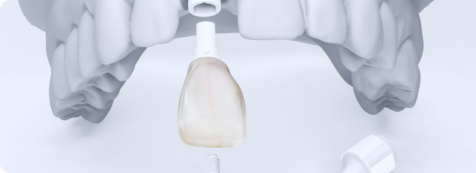 implant unitaire chirurgien dentiste bourgoin jeillieu Implant dentaire Dentistes Bourgoin-Jallieu | Cabinet dentaire Y2