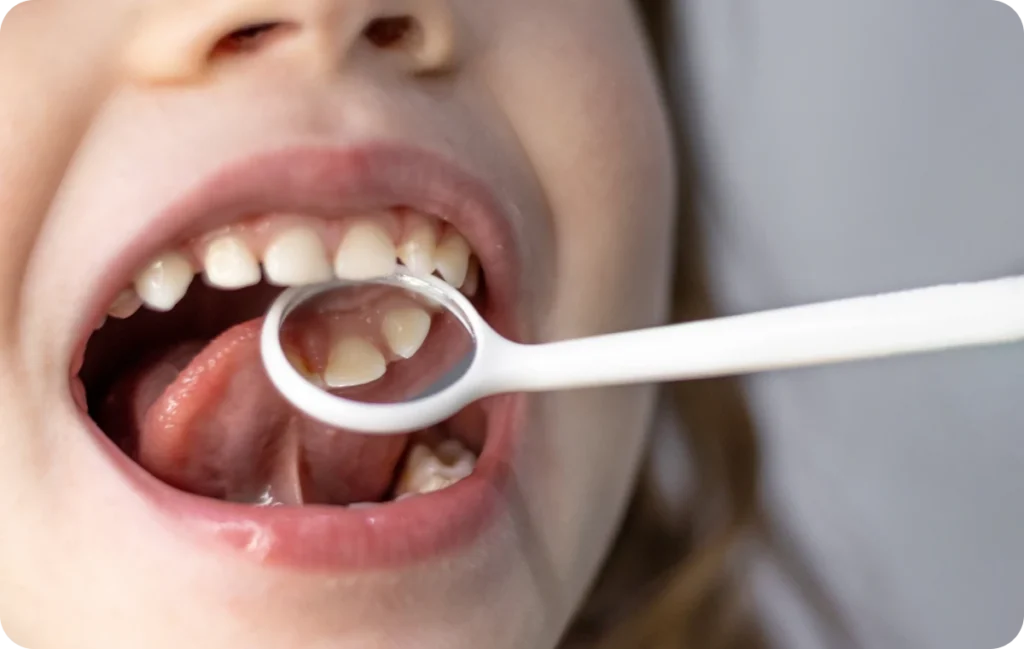 traitement preventif enfant bourgoin jaillieu traitement preventif enfant bourgoin jaillieu Traitement préventif Dentistes Bourgoin-Jallieu | Cabinet dentaire Y2