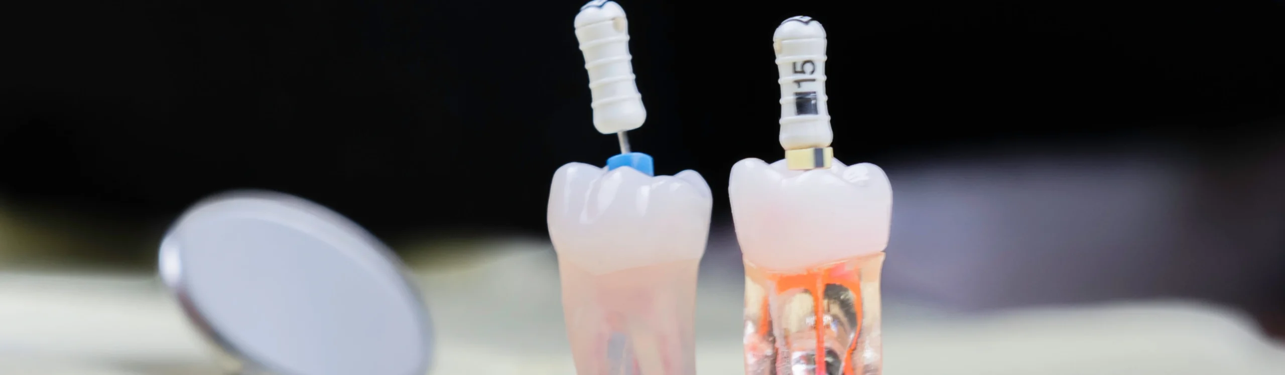 endodontie bourgoin jaillieu scaled Endodontie Dentistes Bourgoin-Jallieu | Cabinet dentaire Y2