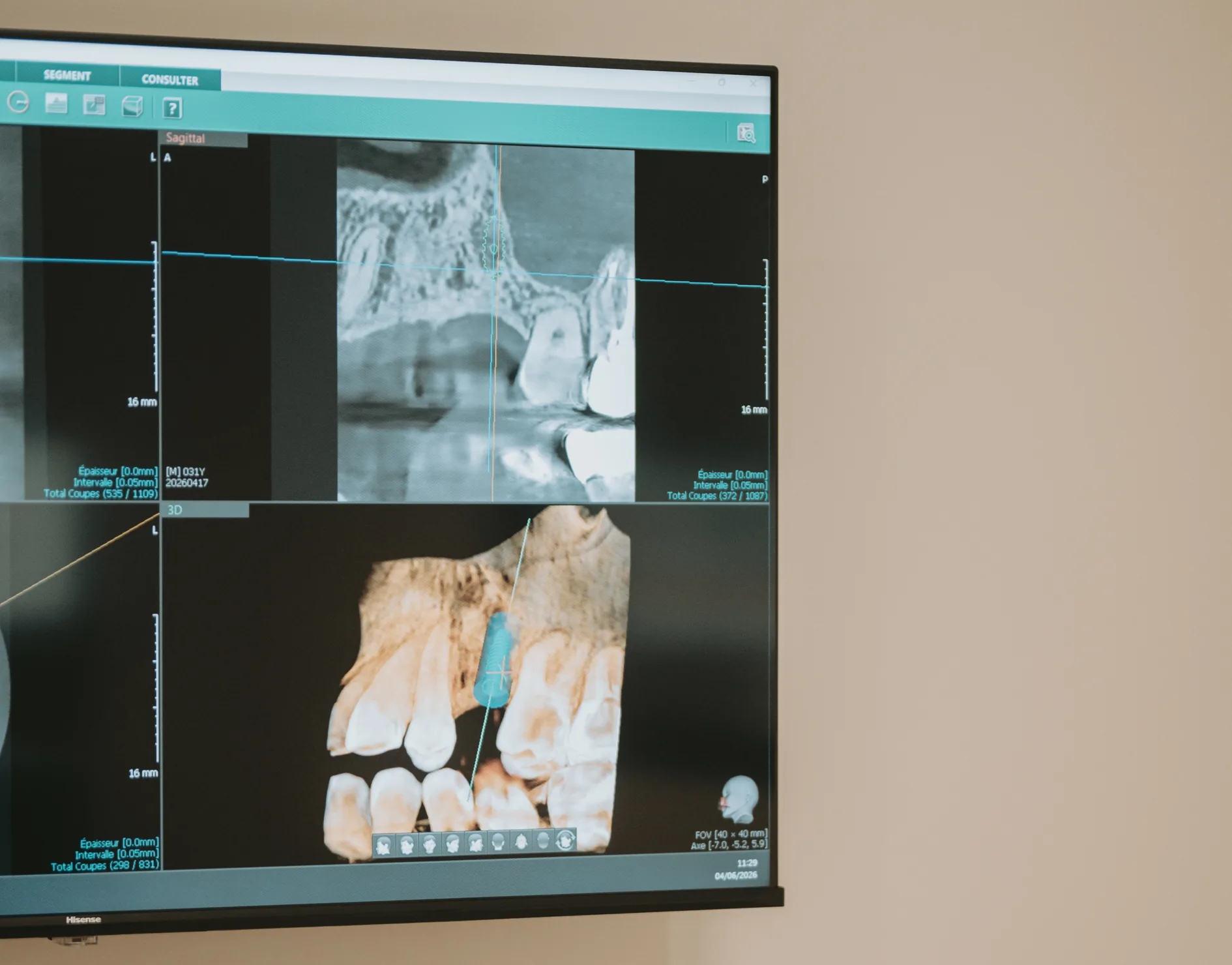 Planification 3D d’un implant en chirurgie guidée sur écran Cone Beam